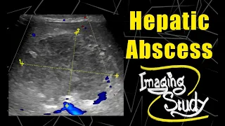 Hepatic Abscess || Ultrasound || Case 73