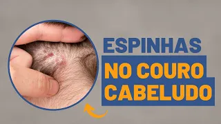 Espinhas no couro cabeludo: o que pode ser?