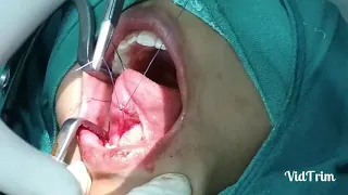 RANULA EXCISION & MARSIPULISATION ,UNEDITED ( DR.ABHAY KUMAR SINGH)