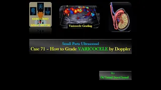 Ultrasound Case 71 - How to grade Varicocele by Doppler