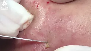 BLACKHEADS AND ACNE REMOVAL #53 | Lấy mụn ẩn dưới da, mụn đầu đen | 黑頭和粉刺去除 | 0934000075