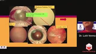 Webinar 2.T1. Tips, Tricks and Traps in endophthalmitis - Dr.Lalit Verma