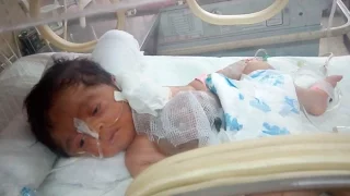 Pakistani Baby Born with Heart Outside Chest