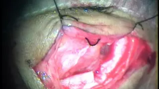 Lateral Orbitotomy