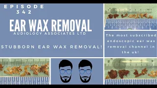 STUBBORN EAR WAX REMOVAL - EP 342