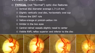 Optic Nerve Evaluation by Dr. Hannah de Guzman