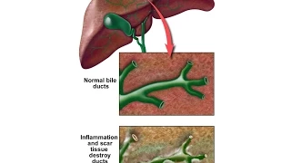 Primary Sclerosing Cholangitis