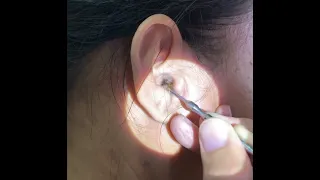 Removing Woman's Giant Earwax Using An Ear Curette