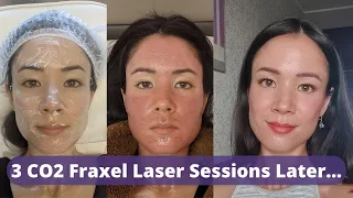 CO2 Fraxel Laser Review 3 Sessions Later - Did My Old Atrophic Acne Scars Improve? | @michxmash