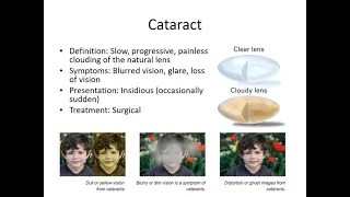 Pseudo-sudden Vision Loss