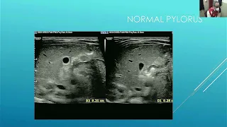 Gastro Intestinal Tract Ultrasound normal