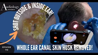 WHOLE EAR CANAL SKIN HUSK REMOVED! - INSIDE & OUT - EP719