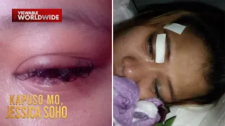 Mata ng isang babae, namula, nagmuta, at namaga dahil sa eyelash extension?| Kapuso Mo, Jessica Soho