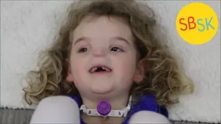 The Girl Born Without a Nose (BAM Syndrome)