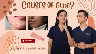 Cause of Acne | Root Causes of Acne | Acne के कारण | Dr. Ankur & Dr. Jushya Bhatia