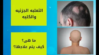 الثعلبه الكليه والجزئيه - Alopecia areata and universalis