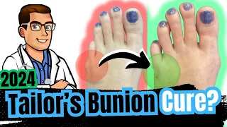 Bunionette Tailor's Bunion Surgery? [Corrector, Splints & Treatment]