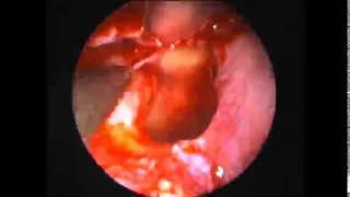 optic nerve decompression by dr jp purohit