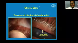 Diagnosis and Management of Dry Eyes