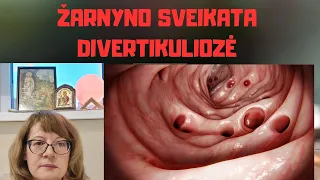 Žarnyno sveikata | Divertikuliozė