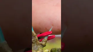 Stung by a Stonefish! (Most Painful Sting)