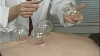 Cupping