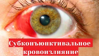 Субконъюнктивальное кровоизлияние (красное пятно на белке) - когда лопнул сосуд на глазу 👀