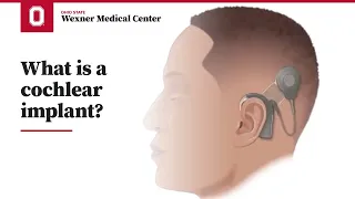 What is a cochlear implant? | Ohio State Medical Center