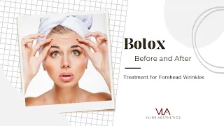 Botox Before and After | Skin Perfect Brothers Medical Spa in Walnut CA