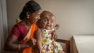 Swollen Head Baby: Roona Begum's Incredible Journey