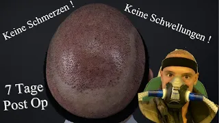 7 Tage nach der Haartransplantation keine Schmerzen und Schwellungen durch Oxycure Behandlung