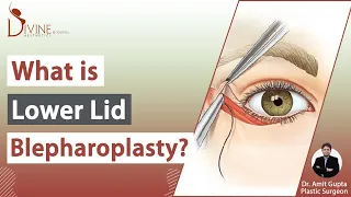 What is Lower Lid Blepharoplasty Surgery? | Divine Cosmetic Surgery