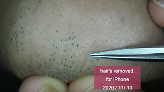 Extractions Unwanted Hair l Tweezers Beard l 2020/11/5