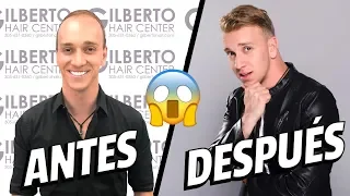 GOODBYE TO BALDNESS! I put on a hair prosthesis - Oscar Alejandro