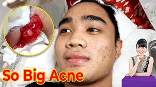 Điều trị mụn hiệu quả tại TPHCM | Hiền Vân spa | Acne treatment | 620