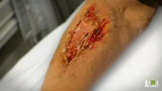 Woman's Arm Literally Eaten Alive by Flesh-Eating Bacteria