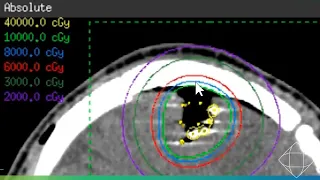 GammaTile For Recurrent Meningiomas | Clinical Webinar Hosted By Dr. Zabramski