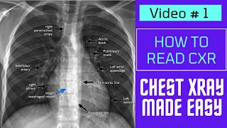 Chest Xray Made Easy by Dr Gireesh Kumar KP