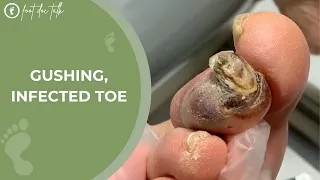 Gushing, Infected Toe