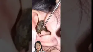 Ear Wax Removal #21