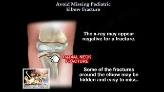 Avoid Missing Pediatric Elbow Fracture - Everything You Need To Know - Dr. Nabil Ebraheim