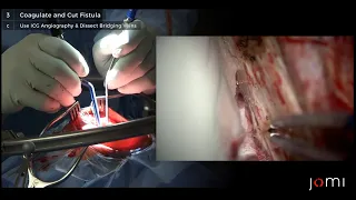 Microsurgical Resection of an Intracranial Dural Arteriovenous Fistula (Links to Full Procedure)