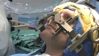 Patient Guide to Deep Brain Stimulation (DBS) Surgery, Mayfield Clinic