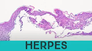 Herpes under the microscope (pathology dermpath dermatology dermatopathology HSV VZV zoster)