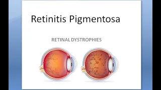 Ophthalmology 297 Retinitis Pigmentosa Dystrophy night blind dominant bone corpuscle ERG vitamin A