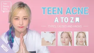 Teen Acne | Acne Meaning & Acne Treatment for Teenage Girls and Boys
