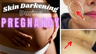 Skin Darkening During Pregnancy | Causes And Treatments