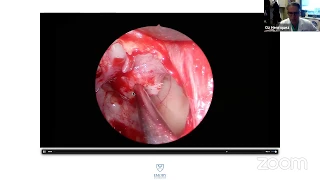 Endoscopic management of orbital trauma