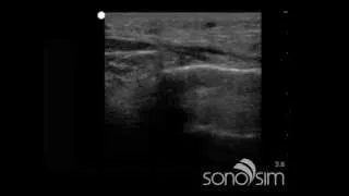 Ultrasound Challenge: SonoSim Ultrasound Challenge - Trauma