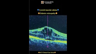 Cystoid macular edema. Diabetic retinopathy.